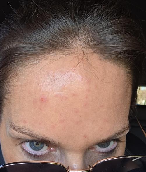 Before treatment
